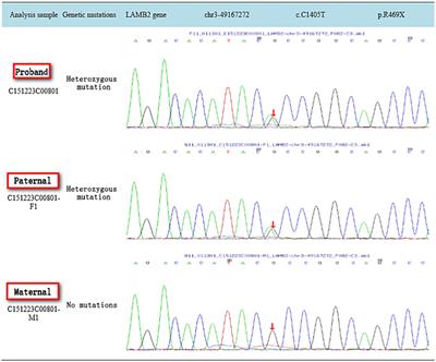 The clinical characteristics and genotype analysis of LAMB2 gene mutation